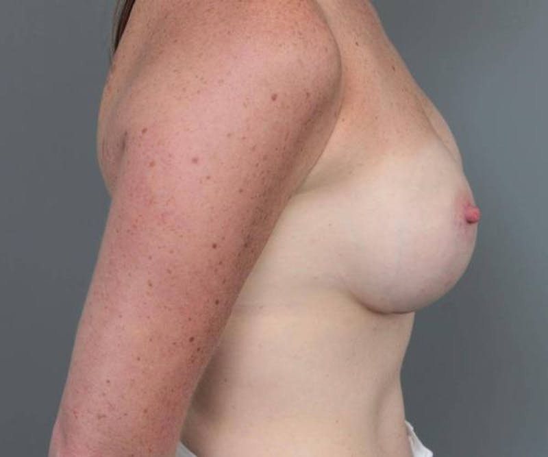 Breast Augmentation Before & After Gallery - Patient 133967 - Image 6 - Scott Chapin, MD