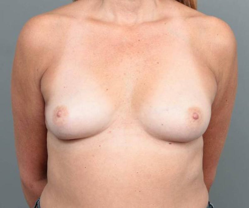 Breast Augmentation Before & After Gallery - Patient 213264 - Image 1 - Scott Chapin, MD