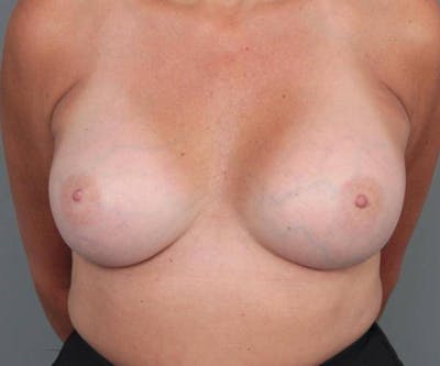 Breast Augmentation Before & After Gallery - Patient 213264 - Image 2 - Scott Chapin, MD