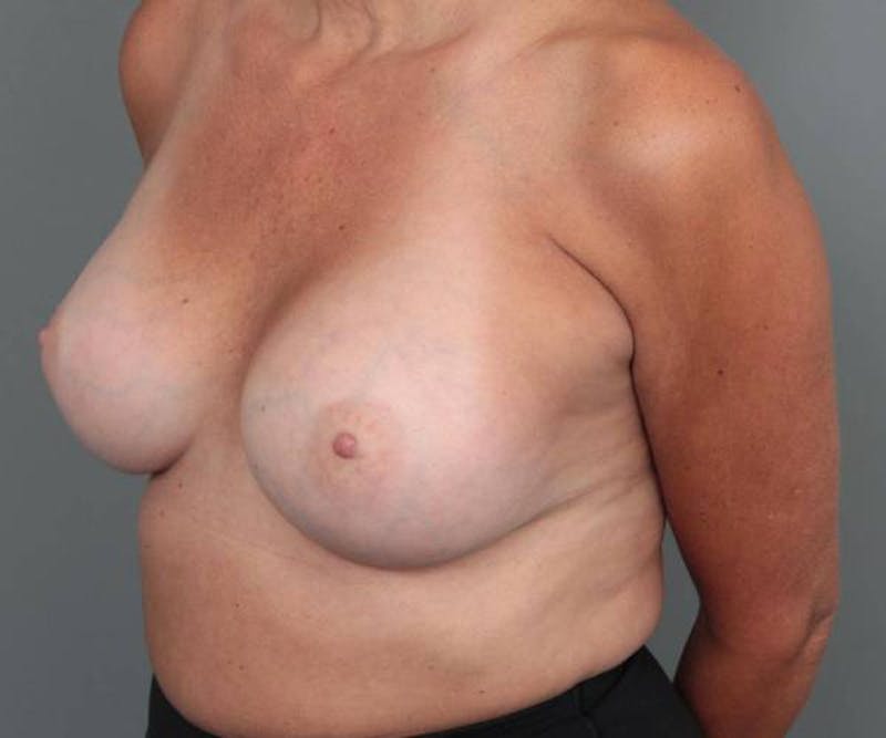 Breast Augmentation Before & After Gallery - Patient 213264 - Image 4 - Scott Chapin, MD