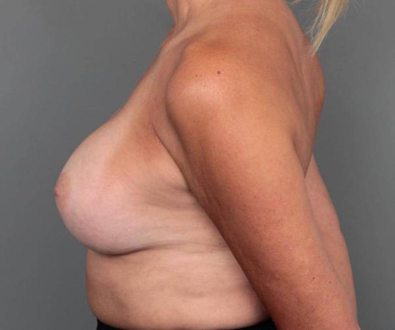 Breast Augmentation Before & After Gallery - Patient 213264 - Image 6 - Scott Chapin, MD