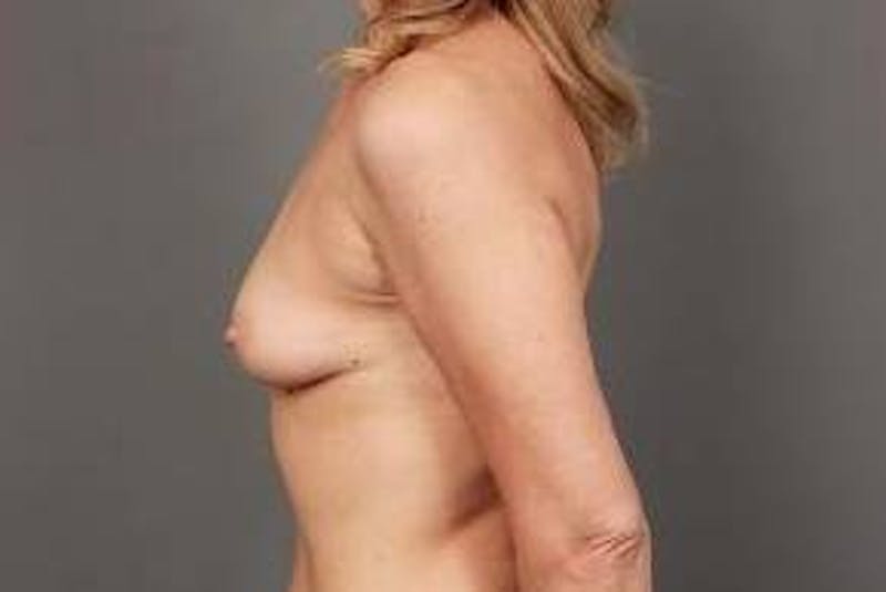Breast Augmentation Before & After Gallery - Patient 188991 - Image 5 - Scott Chapin, MD