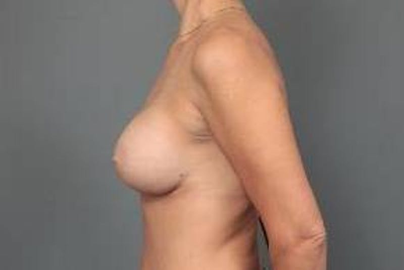 Breast Augmentation Before & After Gallery - Patient 188991 - Image 6 - Scott Chapin, MD