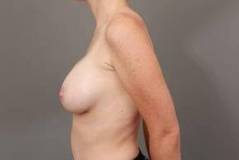 Breast Augmentation Before & After Gallery - Patient 223382 - Image 4 - Scott Chapin, MD