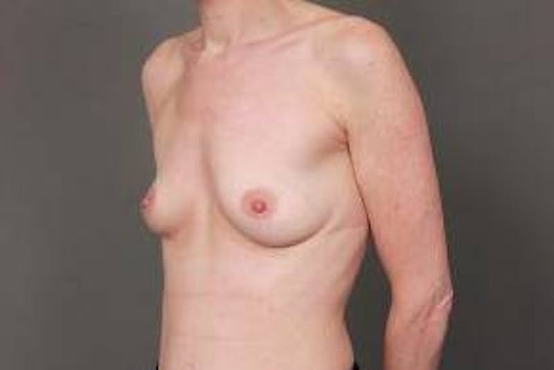 Breast Augmentation Before & After Gallery - Patient 181575 - Image 3 - Scott Chapin, MD