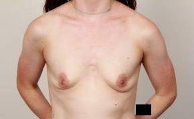 Breast Augmentation Before & After Gallery - Patient 591975 - Image 1 - Scott Chapin, MD