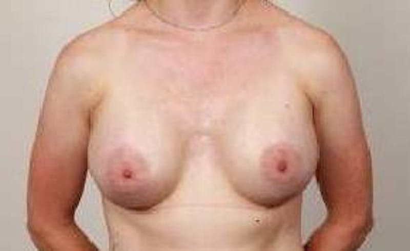 Breast Augmentation Before & After Gallery - Patient 591975 - Image 2 - Scott Chapin, MD