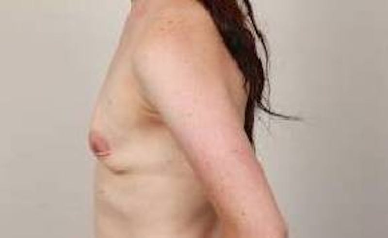 Breast Augmentation Before & After Gallery - Patient 591975 - Image 3 - Scott Chapin, MD
