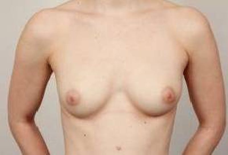 Breast Augmentation Before & After Gallery - Patient 414145 - Image 1 - Scott Chapin, MD