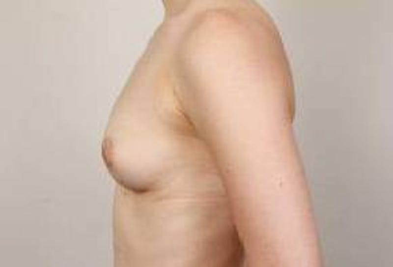 Breast Augmentation Before & After Gallery - Patient 414145 - Image 3 - Scott Chapin, MD