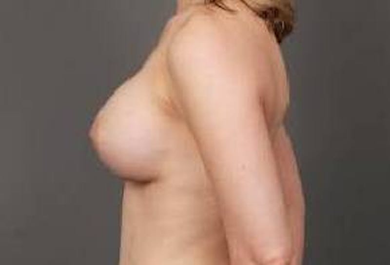 Breast Augmentation Before & After Gallery - Patient 414145 - Image 4 - Scott Chapin, MD