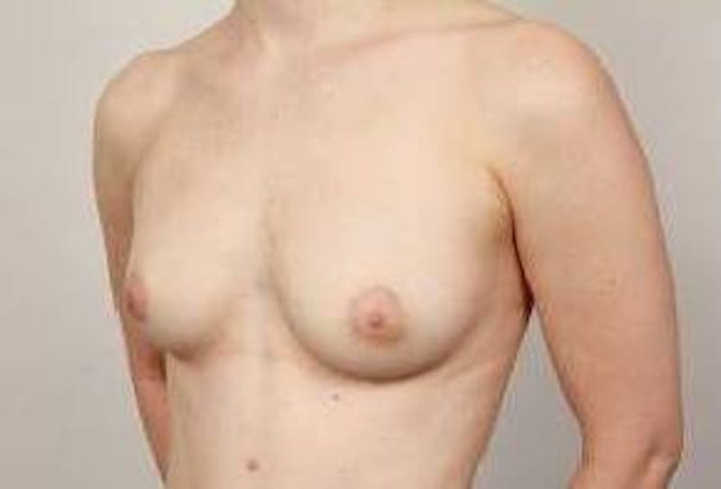 Breast Augmentation Before & After Gallery - Patient 414145 - Image 5 - Scott Chapin, MD