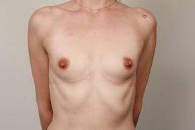 Breast Augmentation Before & After Gallery - Patient 160194 - Image 1 - Scott Chapin, MD