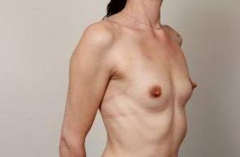 Breast Augmentation Before & After Gallery - Patient 160194 - Image 5 - Scott Chapin, MD