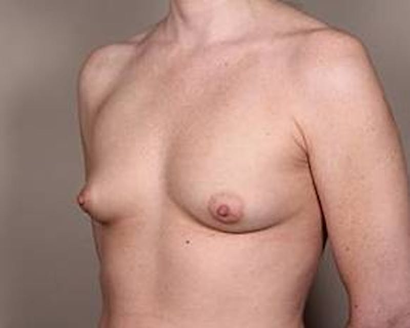 Breast Augmentation Before & After Gallery - Patient 368813 - Image 3 - Scott Chapin, MD