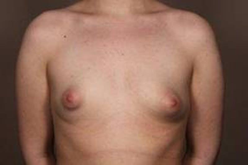 Breast Augmentation Before & After Gallery - Patient 394916 - Image 1 - Scott Chapin, MD