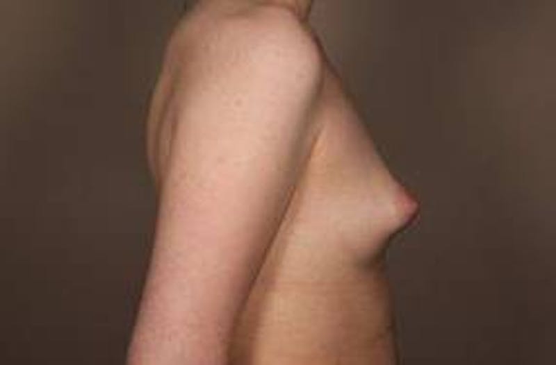 Breast Augmentation Before & After Gallery - Patient 394916 - Image 3 - Scott Chapin, MD