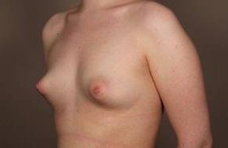 Breast Augmentation Before & After Gallery - Patient 394916 - Image 5 - Scott Chapin, MD