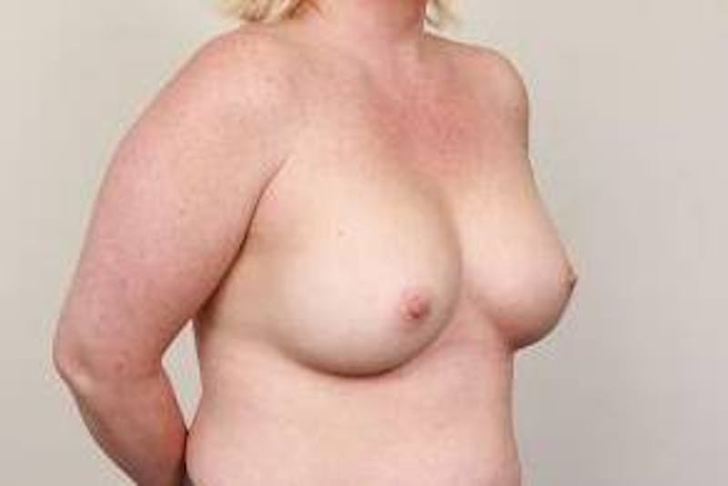 Breast Augmentation Before & After Gallery - Patient 107115 - Image 6 - Scott Chapin, MD