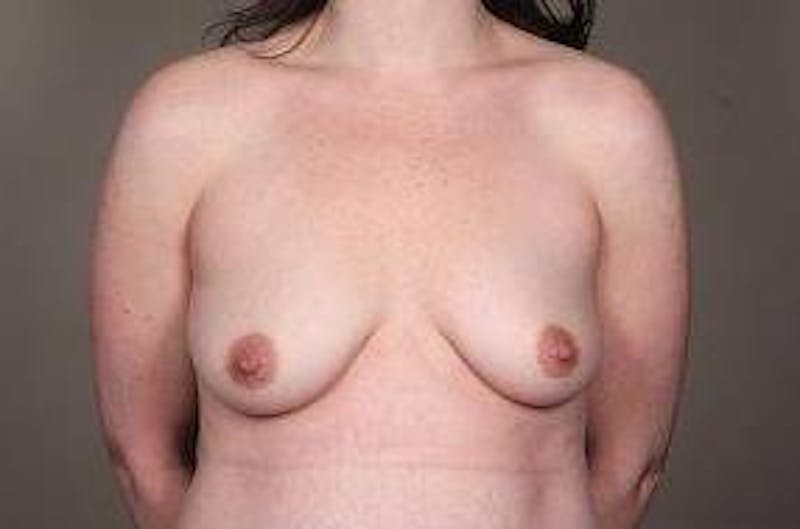 Breast Augmentation Before & After Gallery - Patient 365671 - Image 1 - Scott Chapin, MD