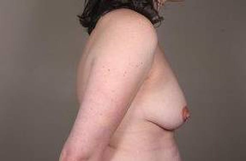Breast Augmentation Before & After Gallery - Patient 365671 - Image 3 - Scott Chapin, MD