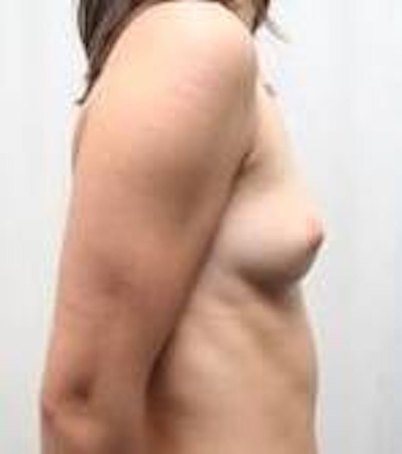 Breast Augmentation Before & After Gallery - Patient 132100 - Image 3 - Scott Chapin, MD