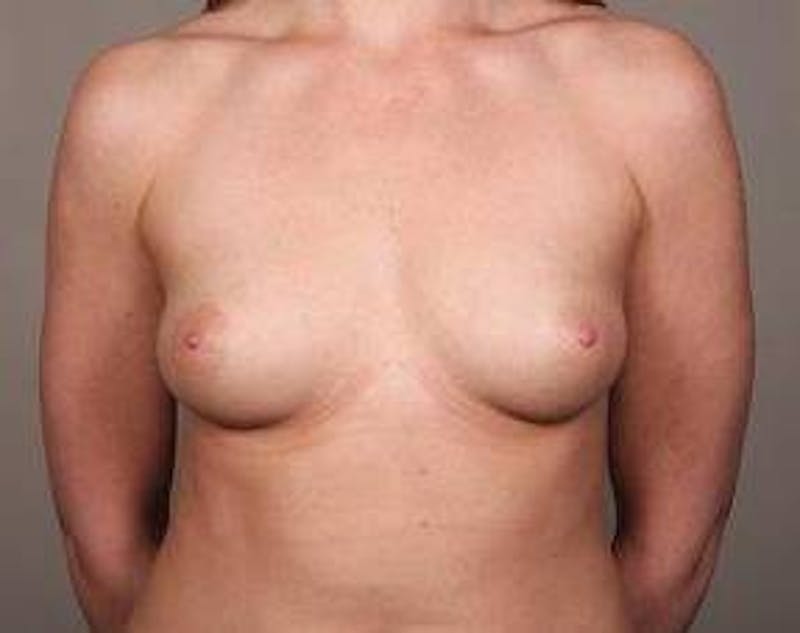 Breast Augmentation Before & After Gallery - Patient 214058 - Image 1 - Scott Chapin, MD