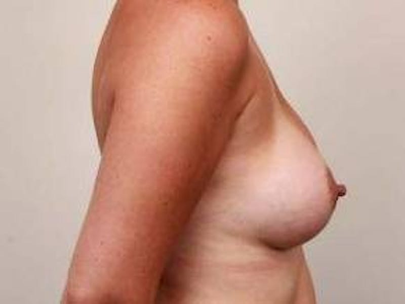 Breast Augmentation Before & After Gallery - Patient 719116 - Image 4 - Scott Chapin, MD