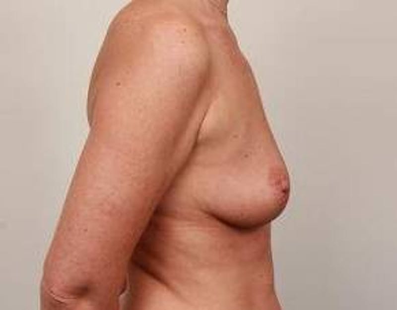 Breast Augmentation Before & After Gallery - Patient 276673 - Image 3 - Scott Chapin, MD