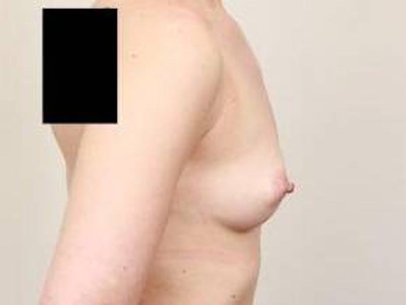 Breast Augmentation Before & After Gallery - Patient 160185 - Image 3 - Scott Chapin, MD