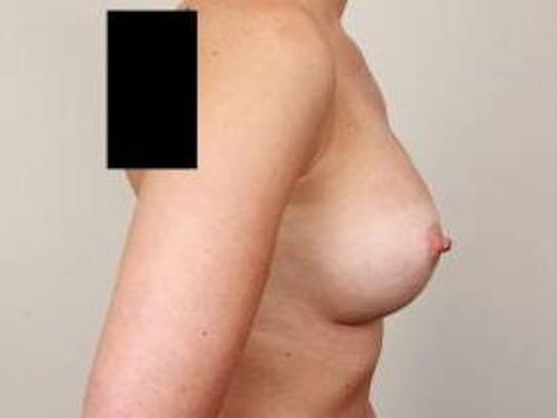Breast Augmentation Before & After Gallery - Patient 160185 - Image 4 - Scott Chapin, MD