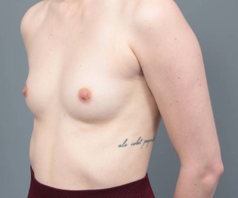 Breast Augmentation Before & After Gallery - Patient 275464 - Image 3 - Scott Chapin, MD