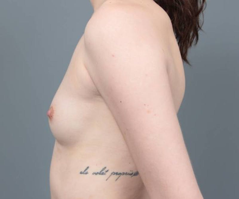 Breast Augmentation Before & After Gallery - Patient 275464 - Image 5 - Scott Chapin, MD
