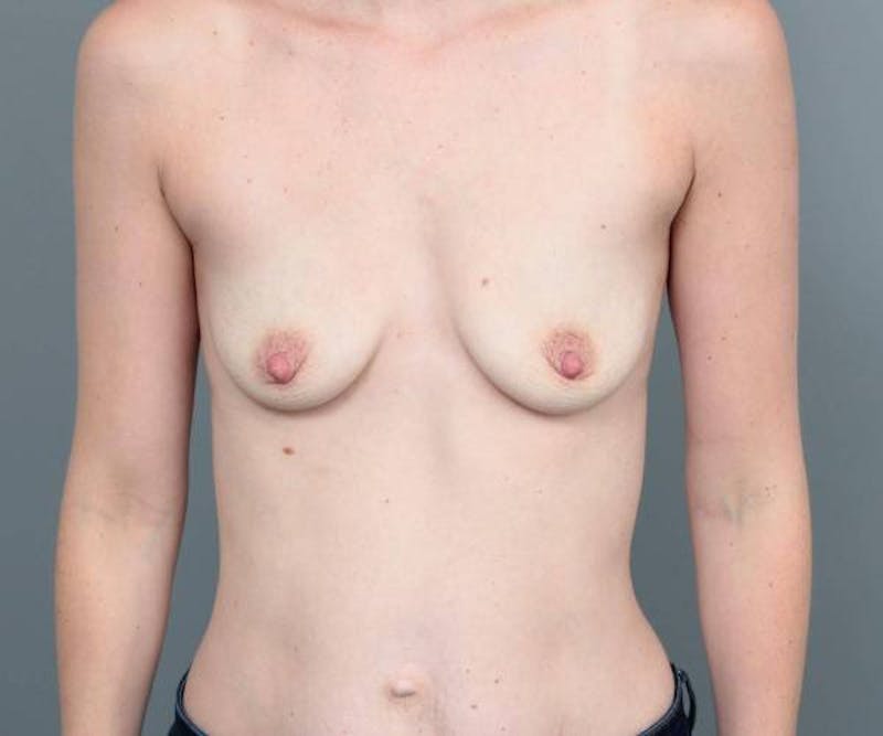 Breast Augmentation Before & After Gallery - Patient 400293 - Image 1 - Scott Chapin, MD