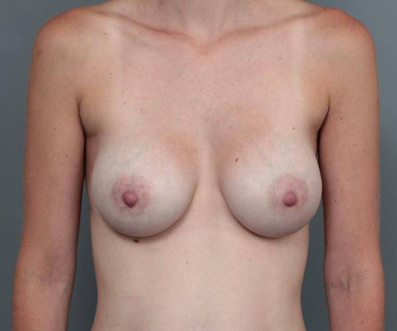 Breast Augmentation Before & After Gallery - Patient 400293 - Image 2 - Scott Chapin, MD