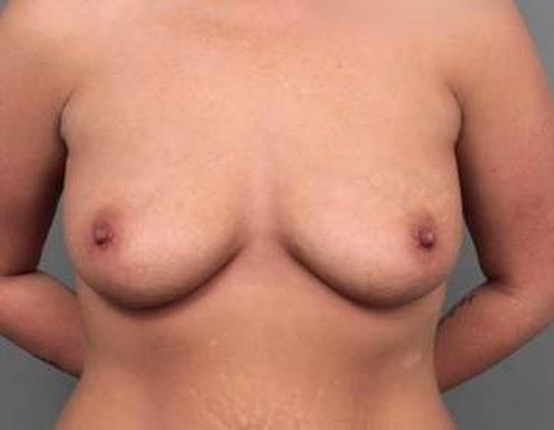 Breast Augmentation Before & After Gallery - Patient 342342 - Image 1 - Scott Chapin, MD