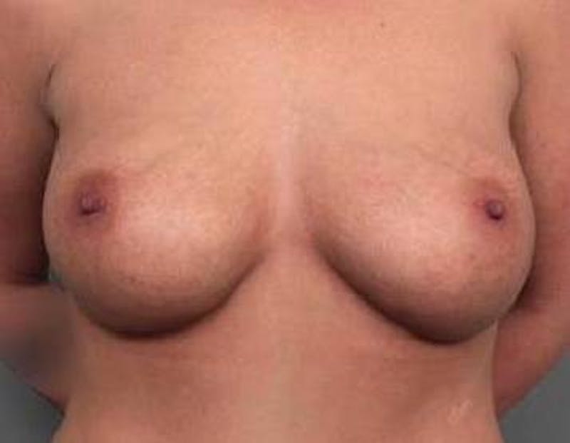Breast Augmentation Before & After Gallery - Patient 342342 - Image 2 - Scott Chapin, MD