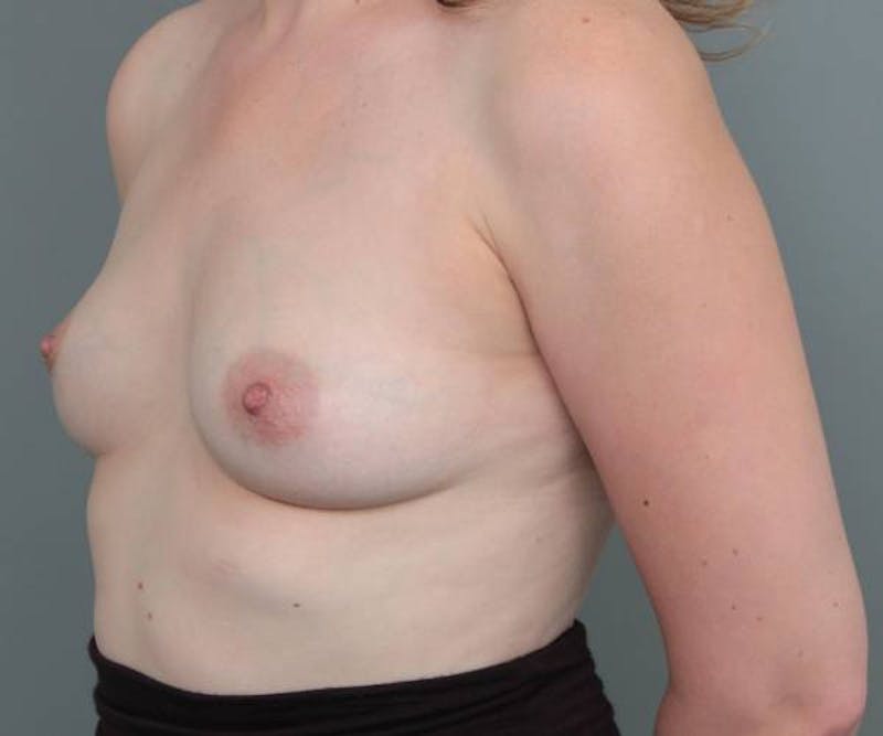 Breast Augmentation Before & After Gallery - Patient 142887 - Image 3 - Scott Chapin, MD