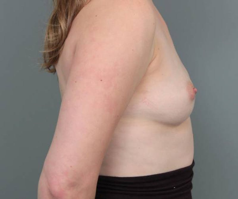 Breast Augmentation Before & After Gallery - Patient 142887 - Image 6 - Scott Chapin, MD