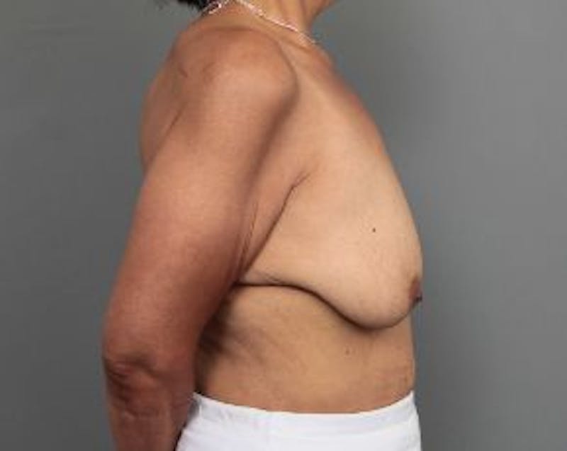 Breast Lift with Augmentation Before & After Gallery - Patient 322896 - Image 5 - Scott Chapin, MD