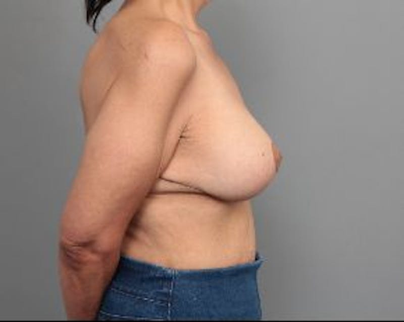 Breast Lift with Augmentation Before & After Gallery - Patient 322896 - Image 6 - Scott Chapin, MD