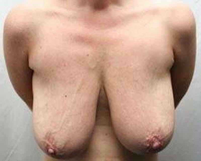 Massive Weight Loss Before & After Gallery - Patient 254168 - Image 1 - Scott Chapin, MD