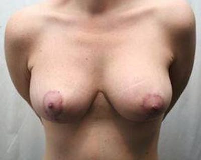 Massive Weight Loss Before & After Gallery - Patient 254168 - Image 2 - Scott Chapin, MD