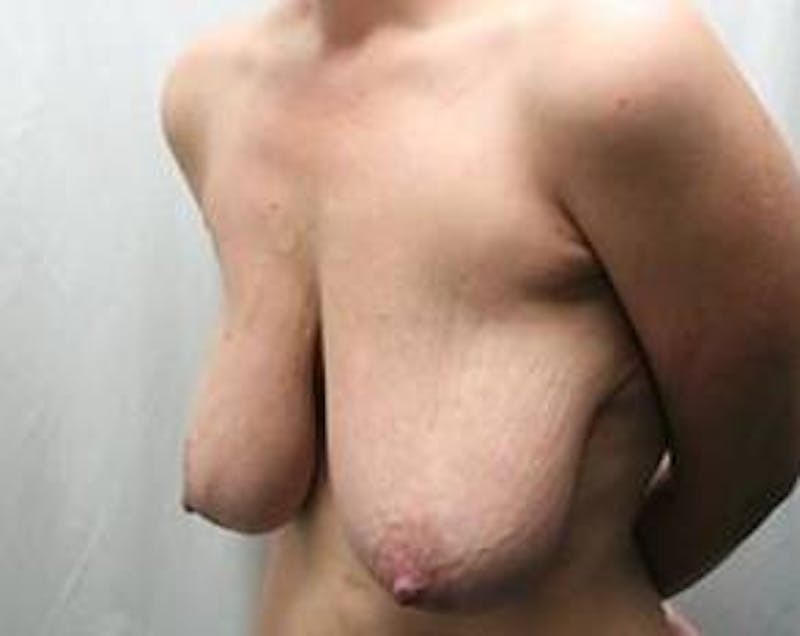 Breast Lift with Augmentation Before & After Gallery - Patient 271205 - Image 5 - Scott Chapin, MD