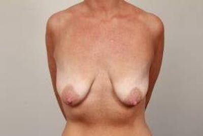 Breast Lift with Augmentation Before & After Gallery - Patient 363276 - Image 1 - Scott Chapin, MD