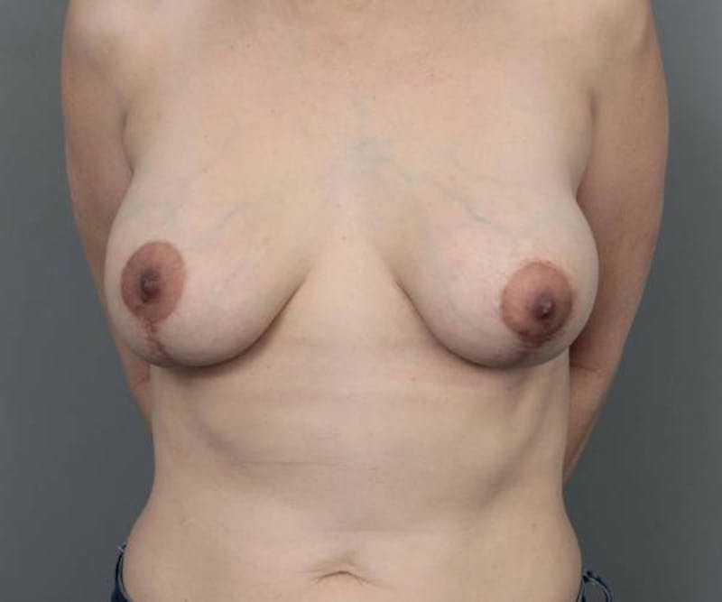 Breast Lift with Augmentation Before & After Gallery - Patient 952965 - Image 2 - Scott Chapin, MD