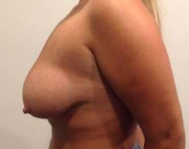Breast Lift with Augmentation Before & After Gallery - Patient 426097 - Image 3 - Scott Chapin, MD