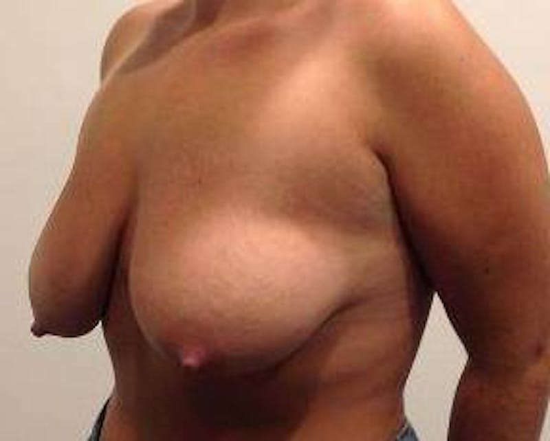 Breast Lift with Augmentation Before & After Gallery - Patient 426097 - Image 5 - Scott Chapin, MD