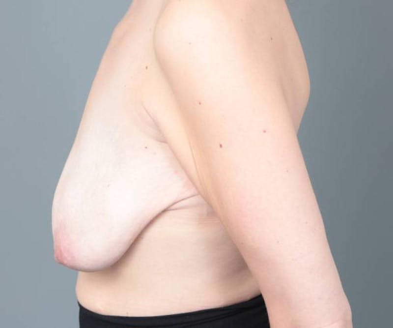 Breast Lift with Augmentation Before & After Gallery - Patient 130774 - Image 5 - Scott Chapin, MD
