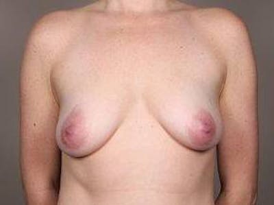 Breast Lift with Augmentation Before & After Gallery - Patient 215549 - Image 1 - Scott Chapin, MD